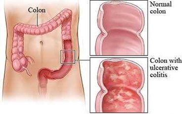 Ulcerative Colitis Condition  Gastroenterology of Greater Orlando